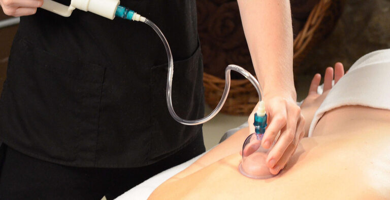 Cupping 2852483 1920 E1619222081452